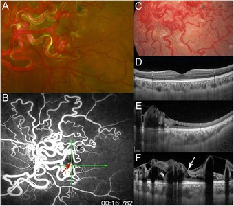 a) Retinal arteriovenous malformations b) direct arteriovenous communication, fovea red arrow c)less dilated and tortuous d)healthy eye e,f) demonstrate retinal edema with cystic changes