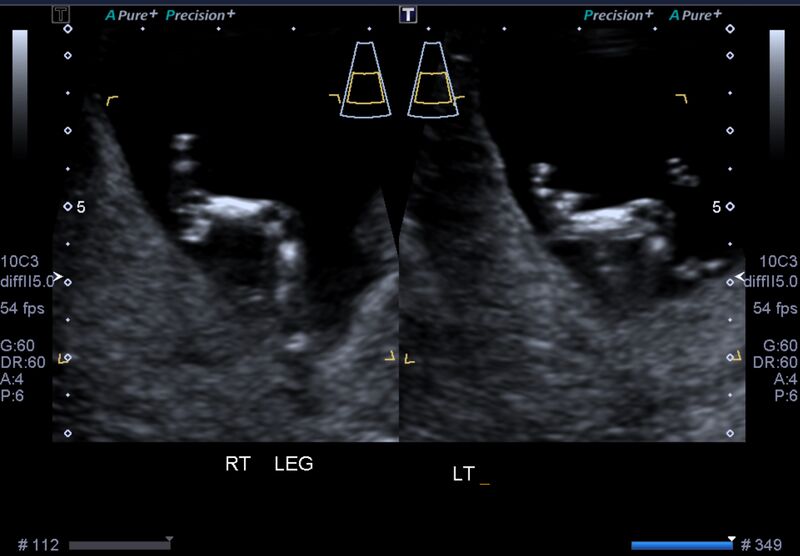 File:1st trimester nuchal-morphology ultrasound (Radiopaedia 44706-48477 General anatomy and NT 29).jpg