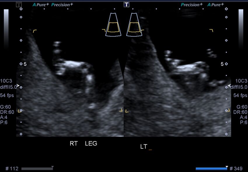 1st trimester nuchal-morphology ultrasound (Radiopaedia 44706-48477 General anatomy and NT 29).jpg