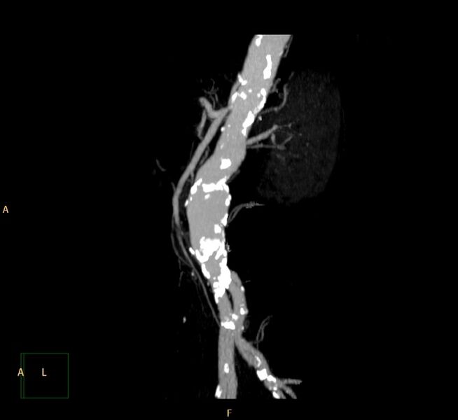 File:Abdominal aortic aneurysm (Radiopaedia 23703-23856 MIP 20).jpg