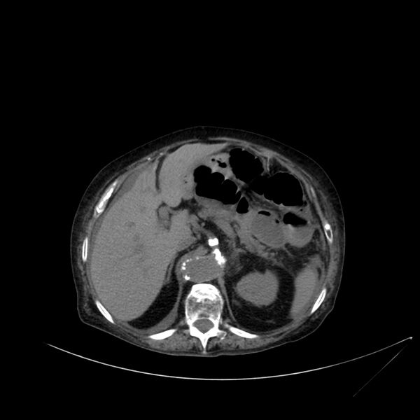 File:Abdominal aortic aneurysm - impending rupture (Radiopaedia 19233-19246 Axial non-contrast 37).jpg