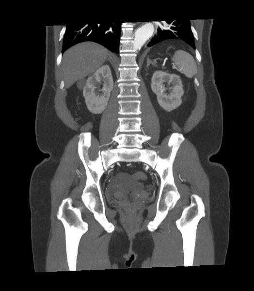 File:Abdominal aortic aneurysm with thrombus fissuration (Radiopaedia 46218-50618 Coronal C+ arterial phase 11).jpg