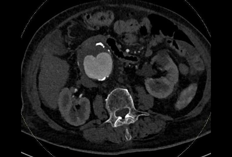 File:Abdominal aortic aneurysm with thrombus fissuration (Radiopaedia 73192-83919 Axial C+ arterial phase 77).jpg