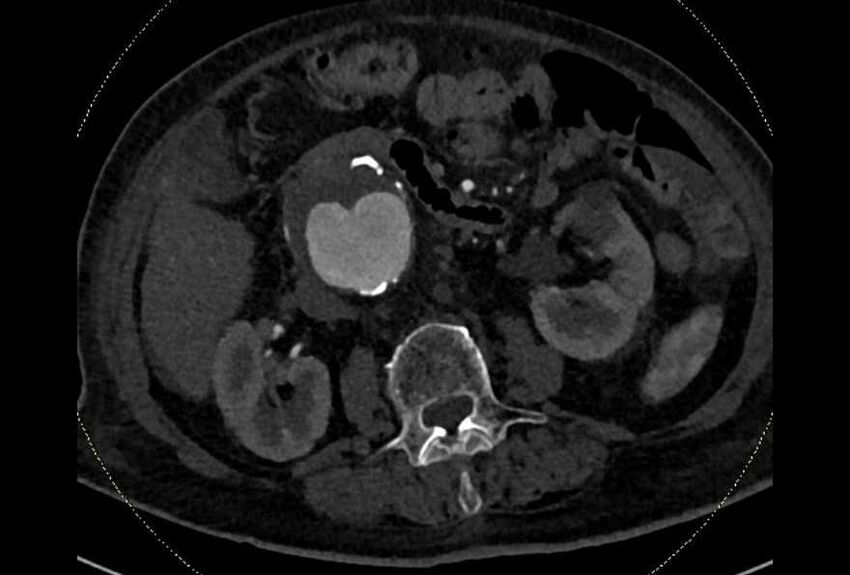 Abdominal aortic aneurysm with thrombus fissuration (Radiopaedia 73192-83919 Axial C+ arterial phase 77).jpg