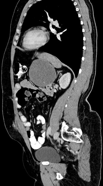 File:Abdominal hydatid disease (Radiopaedia 68223-77737 Sagittal C+ portal venous phase 26).jpg