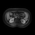 Abdominal wall endometriosis (Radiopaedia 83702-98847 Axial T1 C+ fat sat 2).jpg