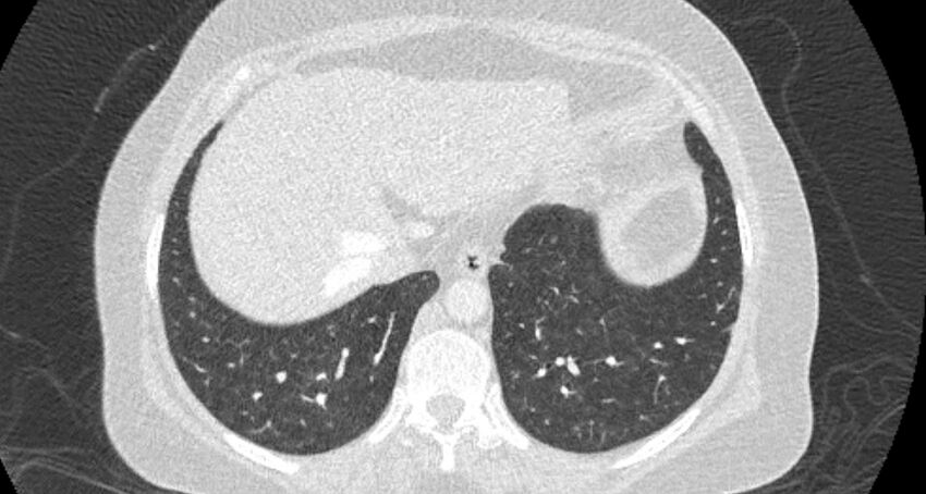 Accessory right inferior hepatic vein (Radiopaedia 65245-74259 Axial lung window 63).jpg