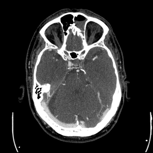 File:Acute A3 occlusion with ACA ischemic penumbra (CT perfusion) (Radiopaedia 72036-82527 Axial C+ arterial phase thins 120).jpg