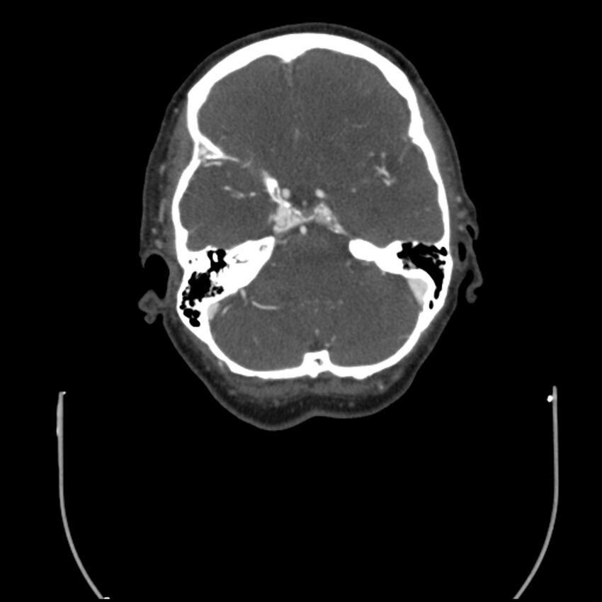 Acute M1 occlusion with ischemic penumbra (CT perfusion) (Radiopaedia 71897-82344 Axial C+ arterial phase thins 106).jpg