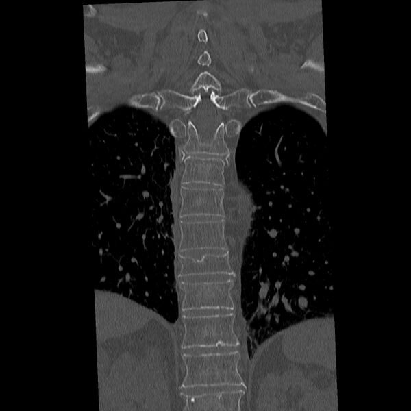 File:Acute and chronic vertebral compression fractures (Radiopaedia 31608-32494 Coronal bone window 27).jpg