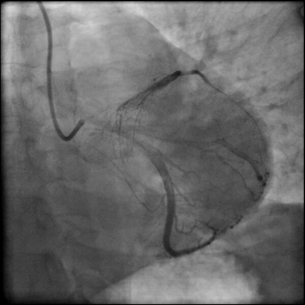 File:Acute anteroseptal myocardial infarction (Radiopaedia 68409-77946 LAO caudal (spider view) LAD and CX 48).jpg