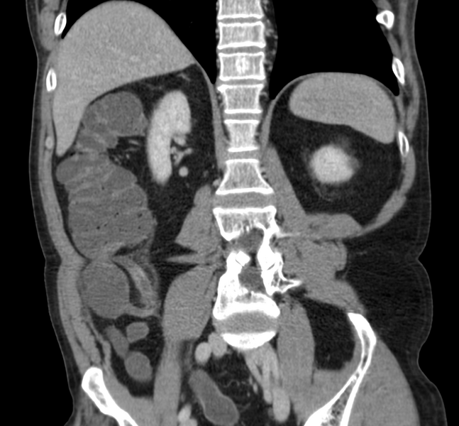 File:Acute appendicitis (Radiopaedia 66513-75792 Curved coronal 1).png