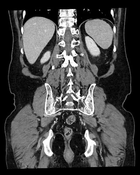 File:Acute appendicitis - large appendicoliths (Radiopaedia 61805-69820 Coronal C+ portal venous phase 103).jpg