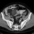 Acute appendicitis arising from a malrotated cecum (Radiopaedia 19970-19997 Axial C+ portal venous phase 36).jpg