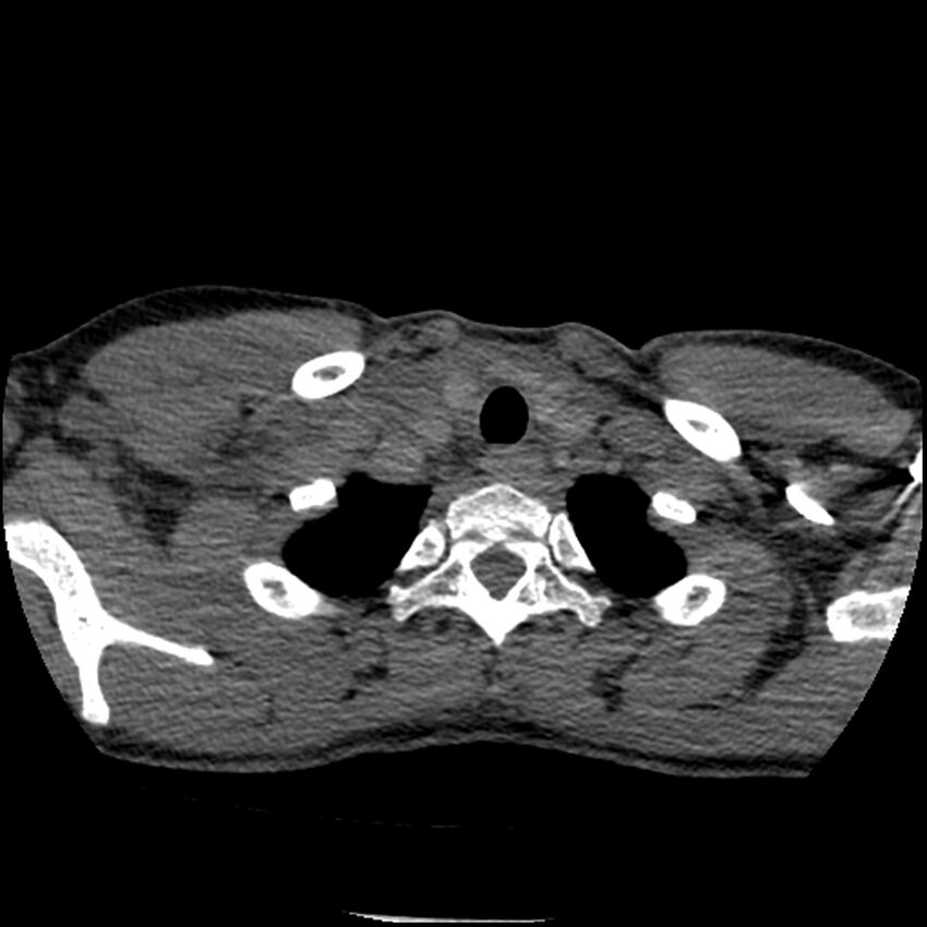 Acute chest syndrome - sickle cell disease (Radiopaedia 42375-45499 Axial C+ CTPA 18).jpg