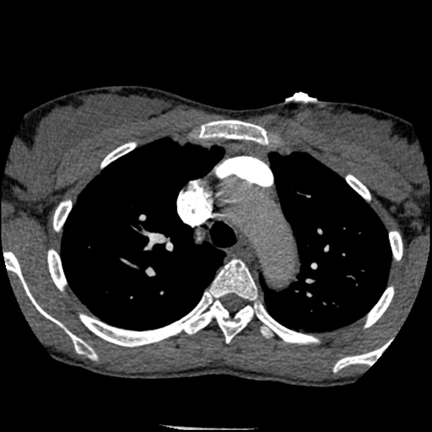 Acute chest syndrome - sickle cell disease (Radiopaedia 42375-45499 Axial C+ CTPA 55).jpg