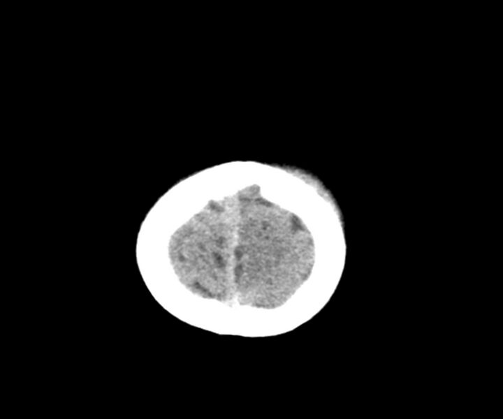 File:Acute epidural hematoma (Radiopaedia 63659-72335 Axial non-contrast 26).jpg