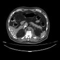 Acute heart failure (CT) (Radiopaedia 79835-93075 Axial C+ arterial phase 93).jpg