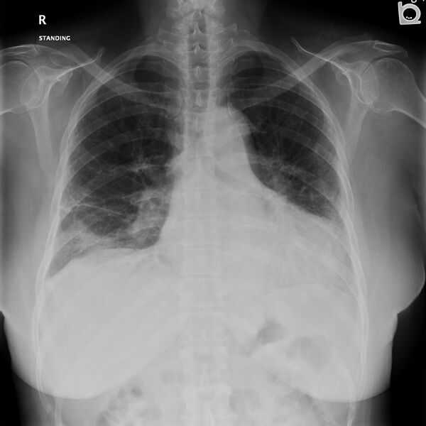File:Acute interstitial pneumonitis (Radiopaedia 45404-49454 Frontal 1).jpg