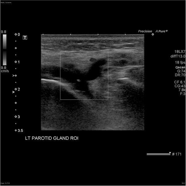 File:Acute left parotid sialadenitis (Radiopaedia 26160-26296 A 2).jpg