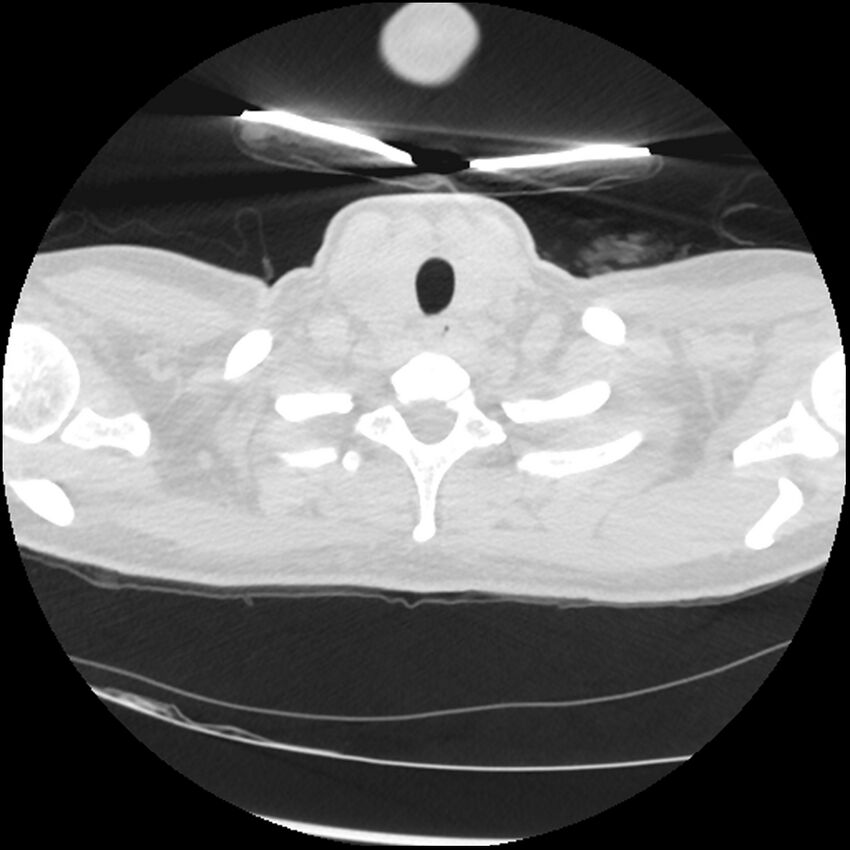 Acute lupus nephritis (Radiopaedia 45832-50107 Axial lung window 2).jpg