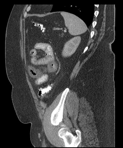 File:Acute mesenteric venous ischemia (Radiopaedia 46041-50383 Sagittal C+ portal venous phase 92).jpg