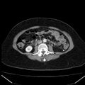 Acute pancreatitis - Balthazar C (Radiopaedia 26569-26714 Axial C+ arterial phase 49).jpg
