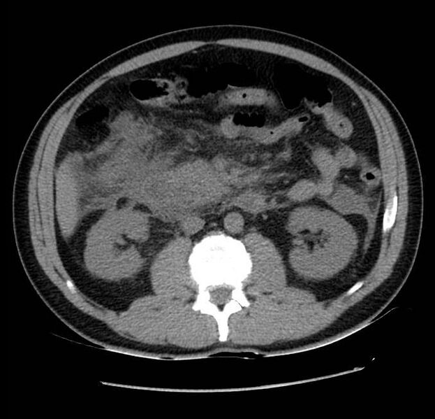 File:Acute pancreatitis - Balthazar E (Radiopaedia 23080-23110 Axial non-contrast 32).jpg