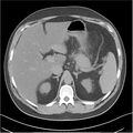Acute pancreatitis - mild (Radiopaedia 27796-28033 Axial non-contrast 5).jpg