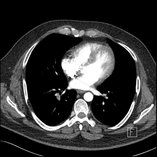 File:Acute pulmonary embolism with pulmonary infarct (Radiopaedia 73062-83768 Axial C+ CTPA 45).jpg