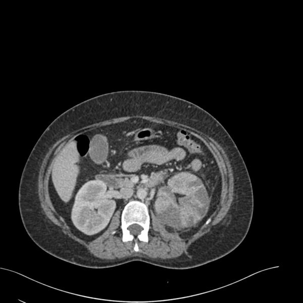 File:Acute pyelonephritis with renal vein thrombosis (Radiopaedia 58020-65053 Axial renal parenchymal phase 61).jpg