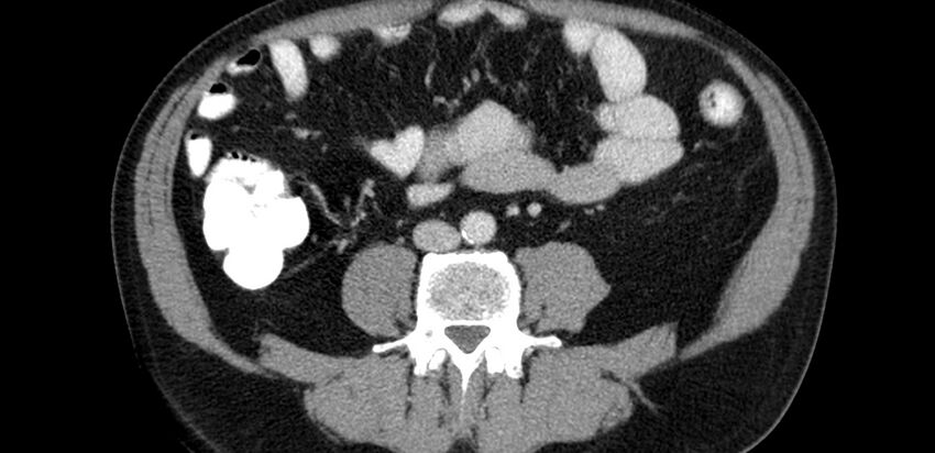 Acute sigmoid colon diverticulitis (Radiopaedia 55507-61976 Axial C+ portal venous phase 40).jpg