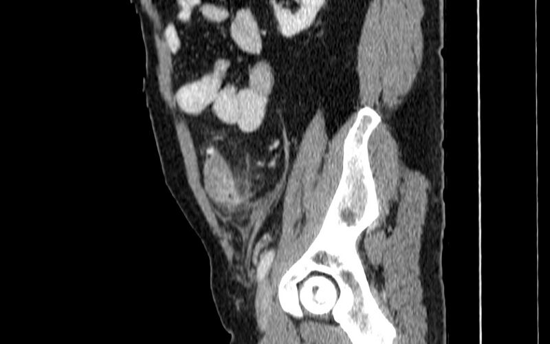 File:Acute sigmoid colon diverticulitis (Radiopaedia 55507-61976 Sagittal C+ portal venous phase 78).jpg