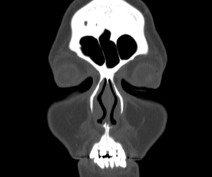 File:Acute sinusitis (Radiopaedia 22419-22455 Coronal bone window 4).jpg