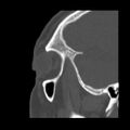 Acute sinusitis (Radiopaedia 23161-23215 Sagittal bone window 54).jpg