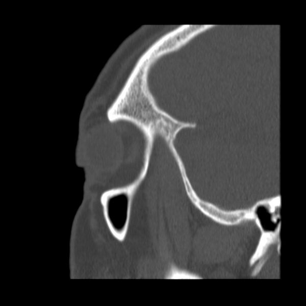 File:Acute sinusitis (Radiopaedia 23161-23215 Sagittal bone window 54).jpg