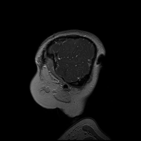 File:Adamantinomatous craniopharyngioma (Radiopaedia 77407-89529 H 110).jpg