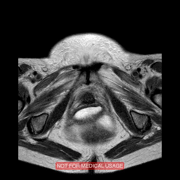 File:Adenocarcinoma of the cervix (Radiopaedia 28373-28615 Axial T2 2).jpg