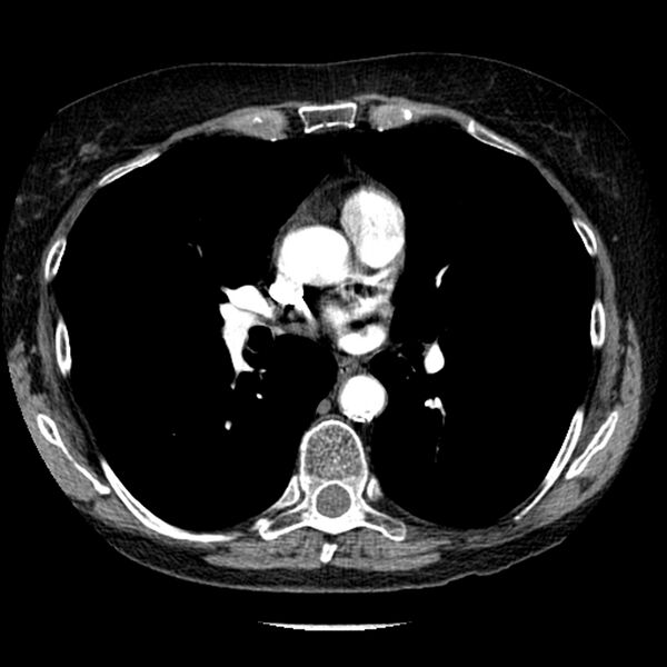 File:Adenocarcinoma of the lung (Radiopaedia 41015-43755 Axial C+ portal venous phase 61).jpg