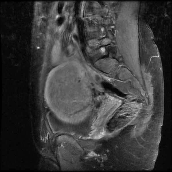 File:Adenomyosis on MRI (Radiopaedia 29328-29780 Sagittal T1 C+ fat sat 5).jpg