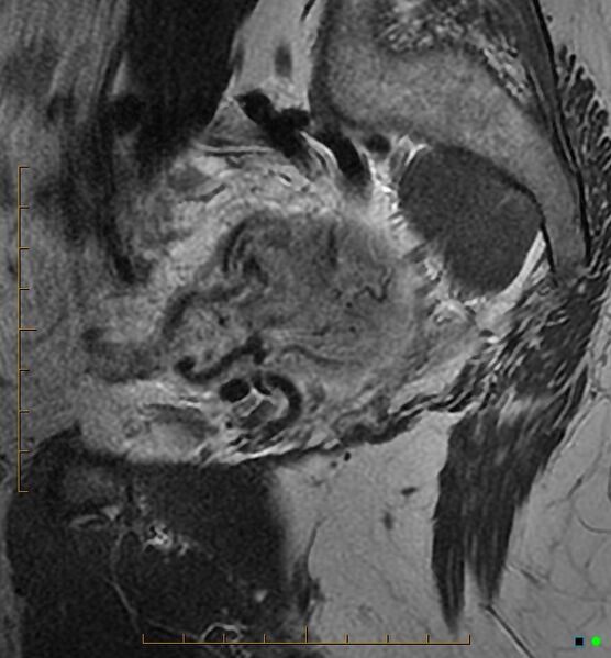 File:Adenomyosis uterus with hematometra (Radiopaedia 45779-50011 Sagittal T2 6).jpg