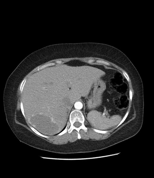 File:Adrenal cortical carcinoma with IVC invasion and thrombosis (Radiopaedia 34307-35597 Axial C+ arterial phase 18).jpg