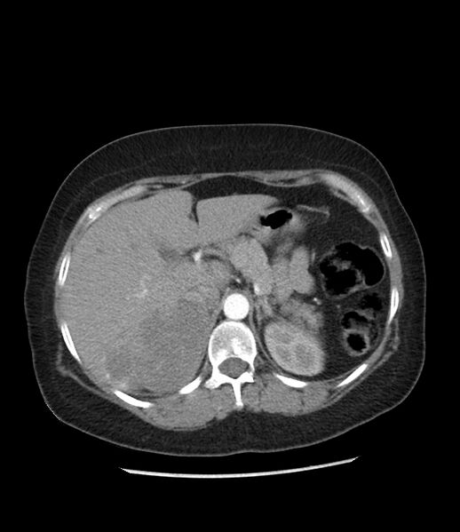 File:Adrenal cortical carcinoma with IVC invasion and thrombosis (Radiopaedia 34307-35597 Axial C+ arterial phase 24).jpg