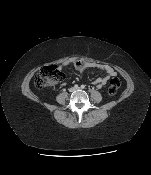 File:Adrenal cortical carcinoma with IVC invasion and thrombosis (Radiopaedia 34307-35597 Axial C+ portal venous phase 55).jpg