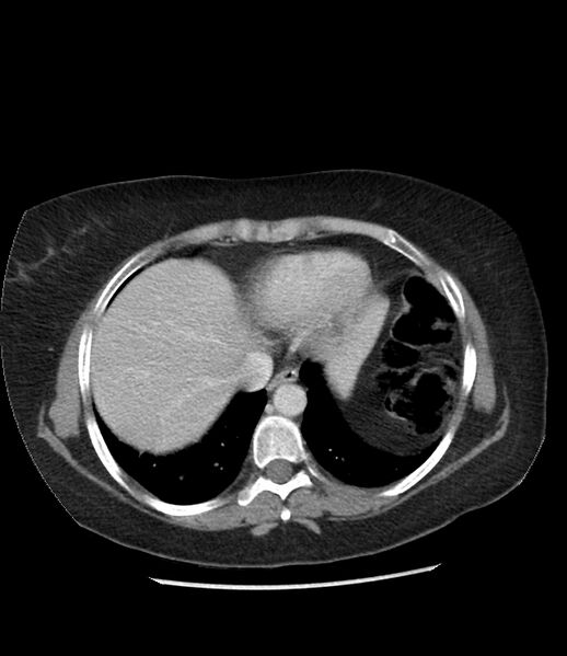 File:Adrenal cortical carcinoma with IVC invasion and thrombosis (Radiopaedia 34307-35597 Axial C+ portal venous phase 9).jpg