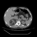 Adrenal myelolipoma (Radiopaedia 41843-44834 Axial non-contrast 19).jpg