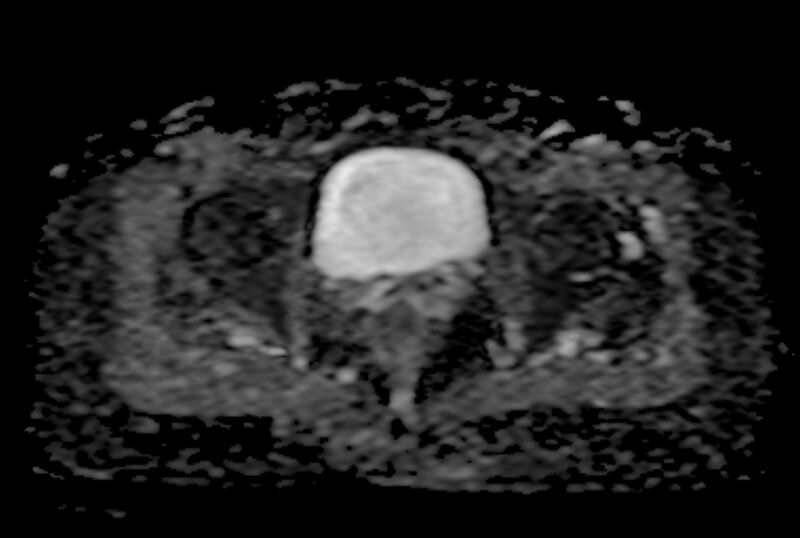 File:Adult granulosa cell tumor of the ovary (Radiopaedia 71581-81950 Axial ADC 21).jpg