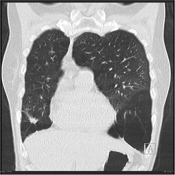 File:Alpha-1-antitrypsin deficiency (Radiopaedia 26537-26678 Coronal lung window 7).jpg