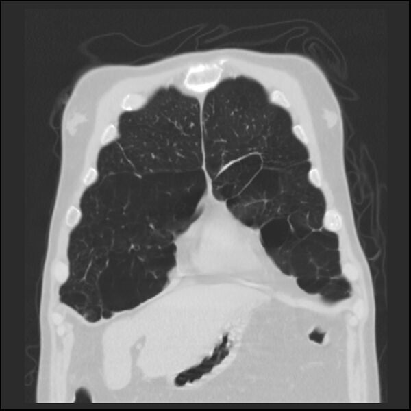 File:Alpha-1-antitrypsin deficiency (Radiopaedia 40993-43722 Coronal lung window 15).jpg