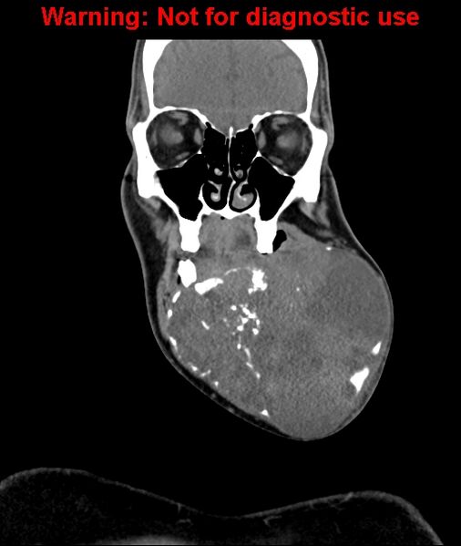 File:Ameloblastoma (Radiopaedia 33126-34164 D 22).jpg